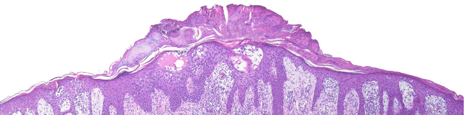 Histologie Urtikaria